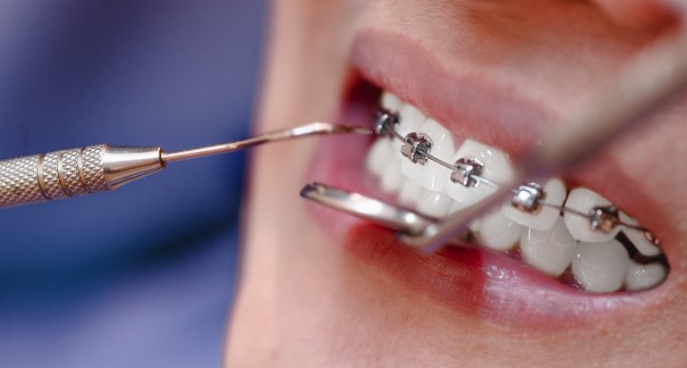 When Is Orthodontic Treatment Necessary?