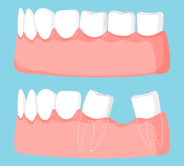 Dental Implants In Chihuahua Mexico As A Solution For Missing Teeth los angeles dental center