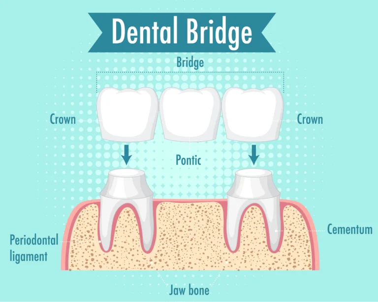 The Role Of Dental Bridges In Restoring Smiles In Chihuahua Mexico los angeles dental center