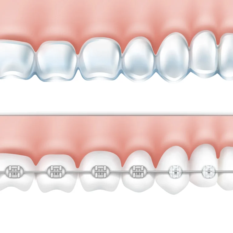Difference Between Braces And Aligners In Orthodontics In Chihuahua Mexico los angeles dental center