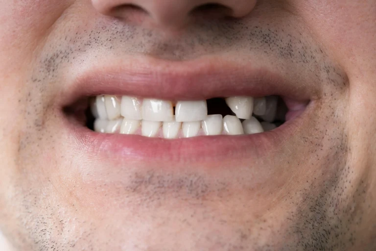 What Happens If You Delay Replacing a Missing Tooth in los angeles chihuahua dental implants
