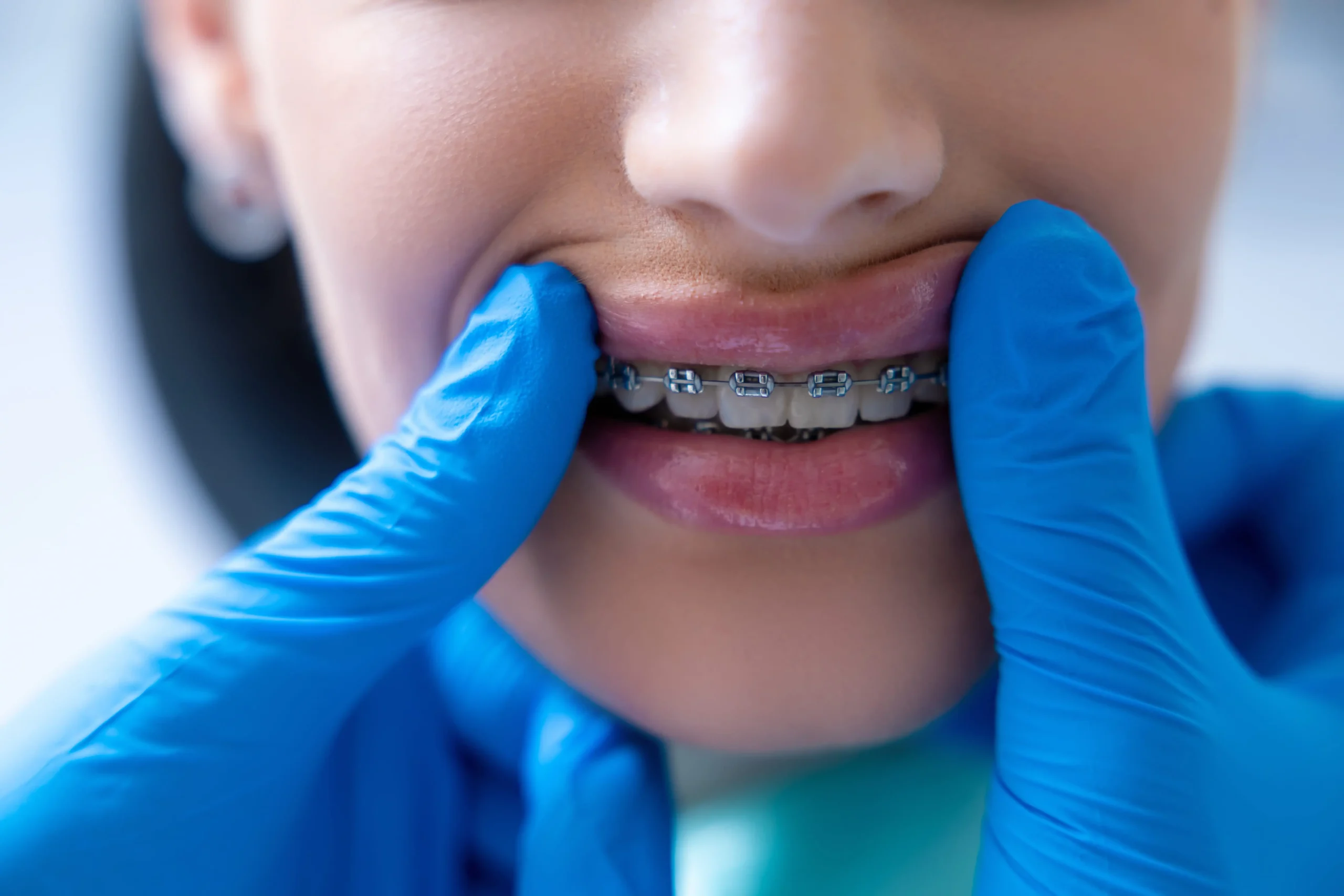 Orthodontics for Teenagers: The Best Age to Start Treatment